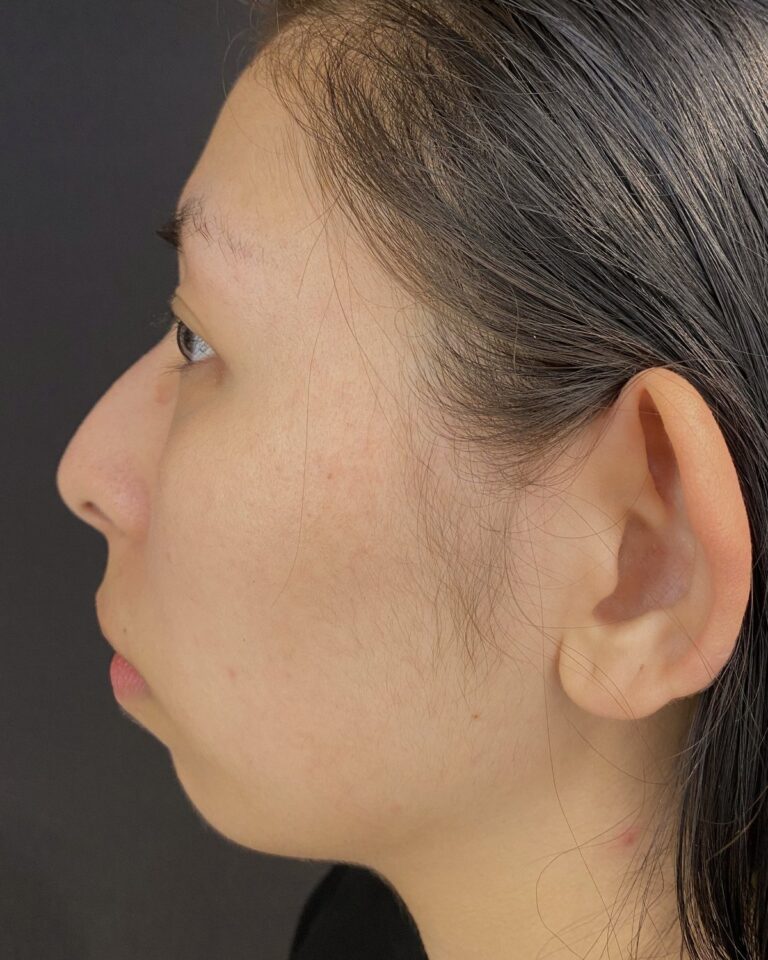Før: Hage med 1 ml ikke-permanent filler. Kvinde, 29 år.