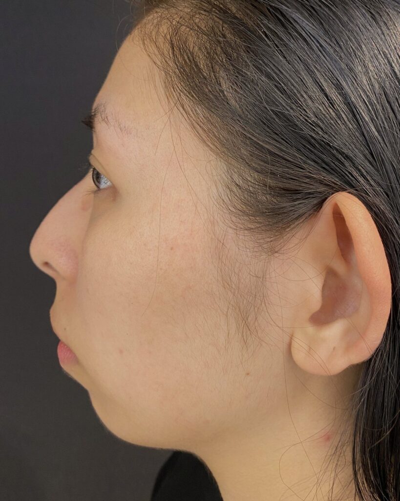 Før: Hage med 1 ml ikke-permanent filler. Kvinde, 29 år.