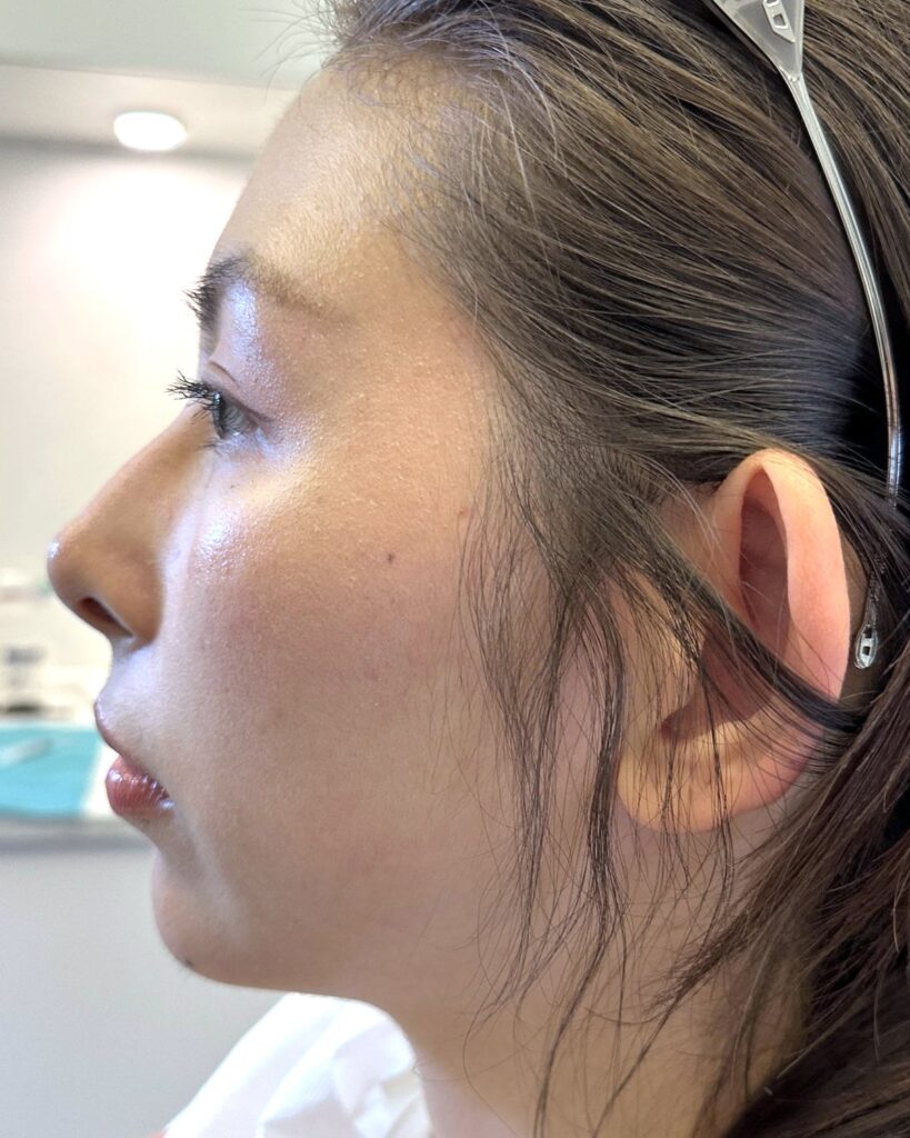 Efter, 4 uger efter behandlingen: Hage med 1 ml ikke-permanent filler. Kvinde, 29 år.