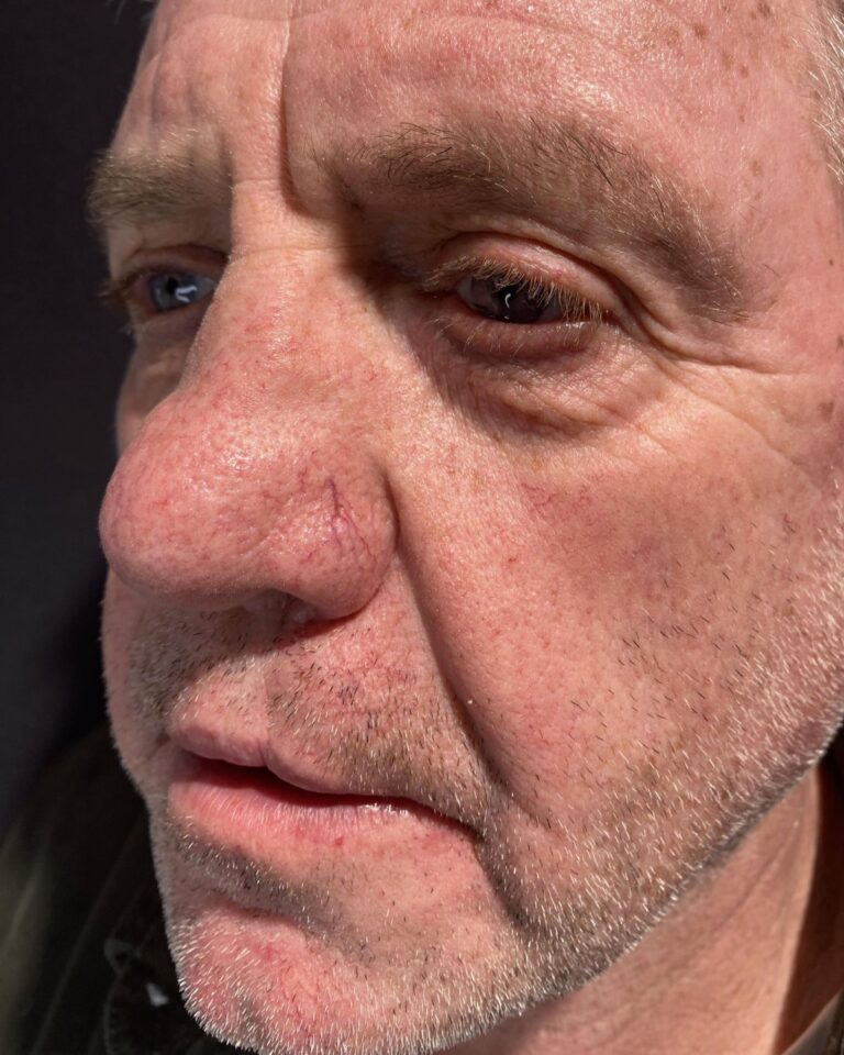 Før: IPL mod karsprængninger på næsen. Mand, 63 år.