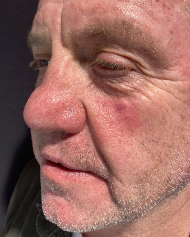 Efter, lige efter behandlingen: IPL mod karsprængninger på næsen. Mand, 63 år.