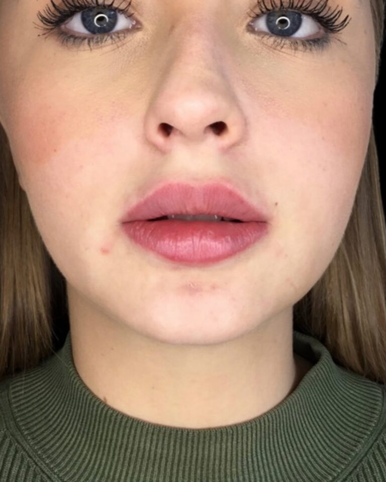 Efter, 2 uger efter behandlingen: Læbeforstørrelse 0,5 ml ikke-permanent filler. Kvinde, 22 år.