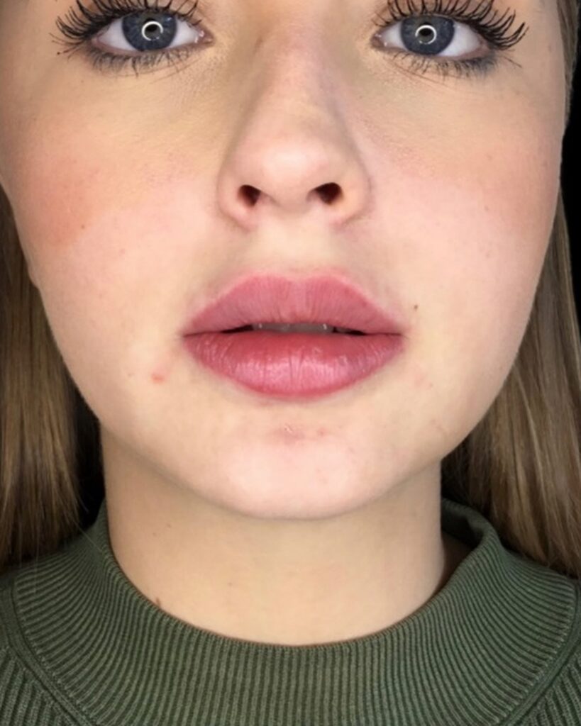 Efter, 2 uger efter behandlingen: Læbeforstørrelse 0,5 ml ikke-permanent filler. Kvinde, 22 år.