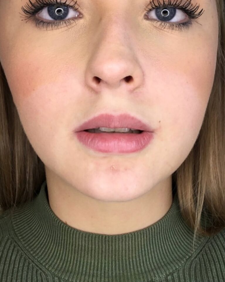 Før: Læbeforstørrelse 0,5 ml ikke-permanent filler. Kvinde, 22 år.