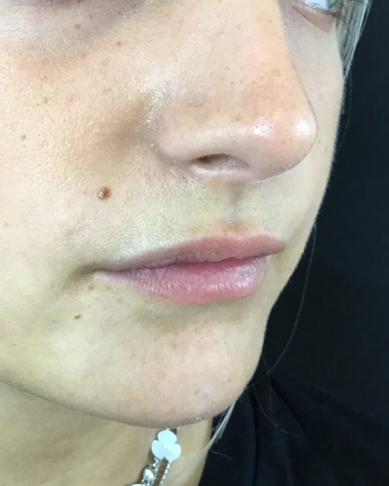 Efter, lige efter behandlingen: Udfyldning af hage 1 ml ikke-permanent filler. Kvinde, 22 år.