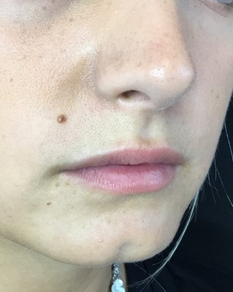 Før: Udfyldning af hage 1 ml ikke-permanent filler. Kvinde, 22 år.