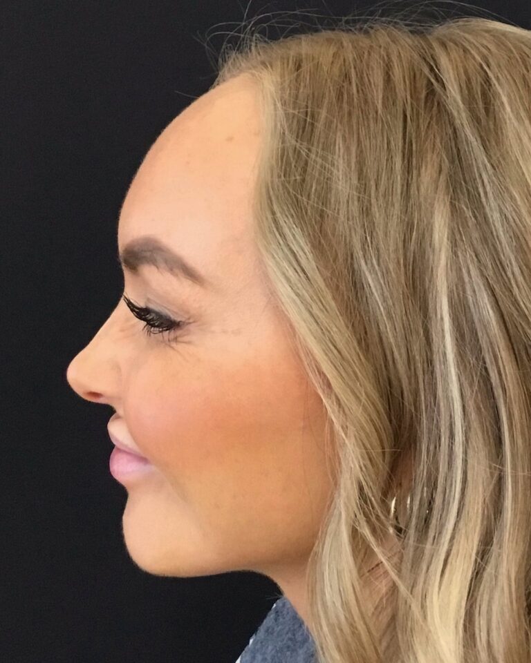 Efter, 2 uger efter behandlingen: Botox i kragetæer. Kvinde, 25 år.