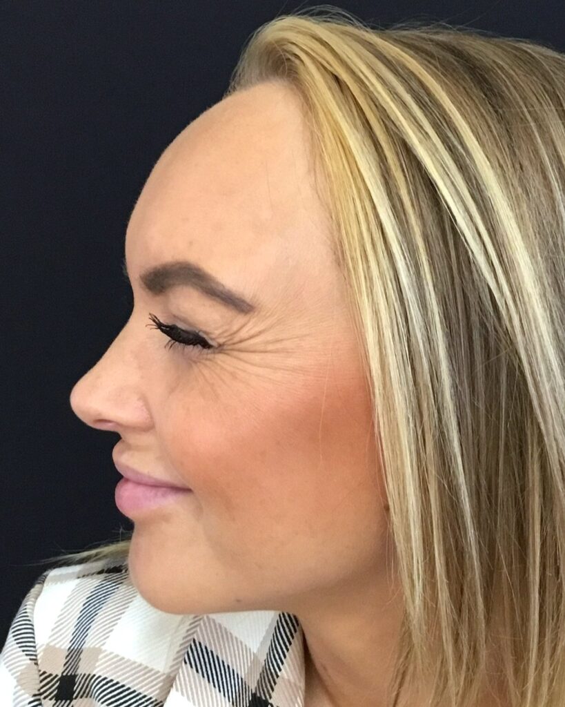 Før: Botox i kragetæer. Kvinde, 25 år.