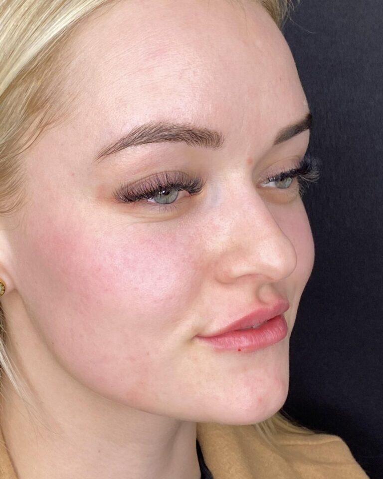 Efter, lige efter behandlingen: Læbevolumen med 0,5 ml ikke-permanent filler. Kvinde, 21 år.