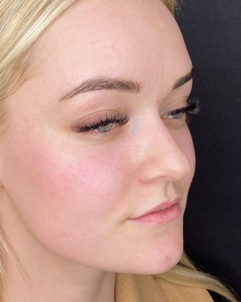 Før: Læbevolumen med 0,5 ml ikke-permanent filler. Kvinde, 21 år.