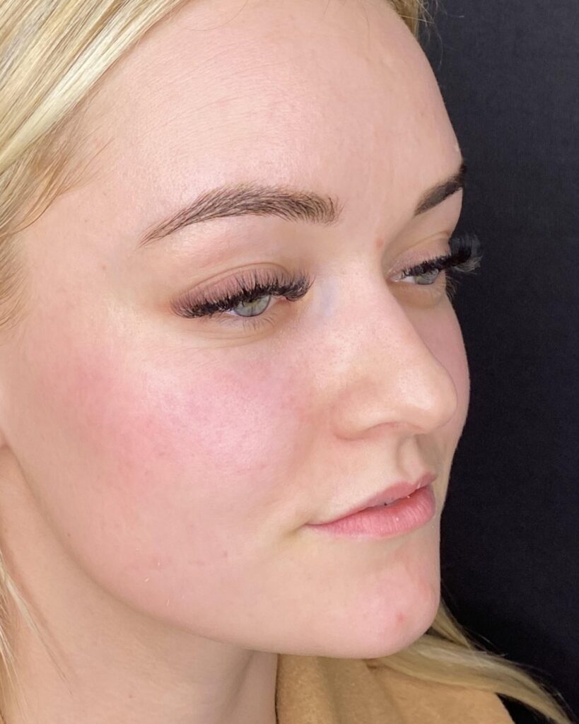 Før: Læbevolumen med 0,5 ml ikke-permanent filler. Kvinde, 21 år.
