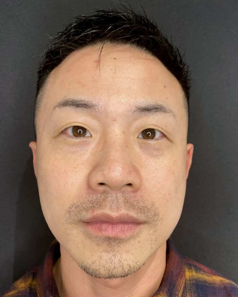 Efter, 6 måneder efter behandlingen: Botox i masseter for V-shape. Mand, 33 år.