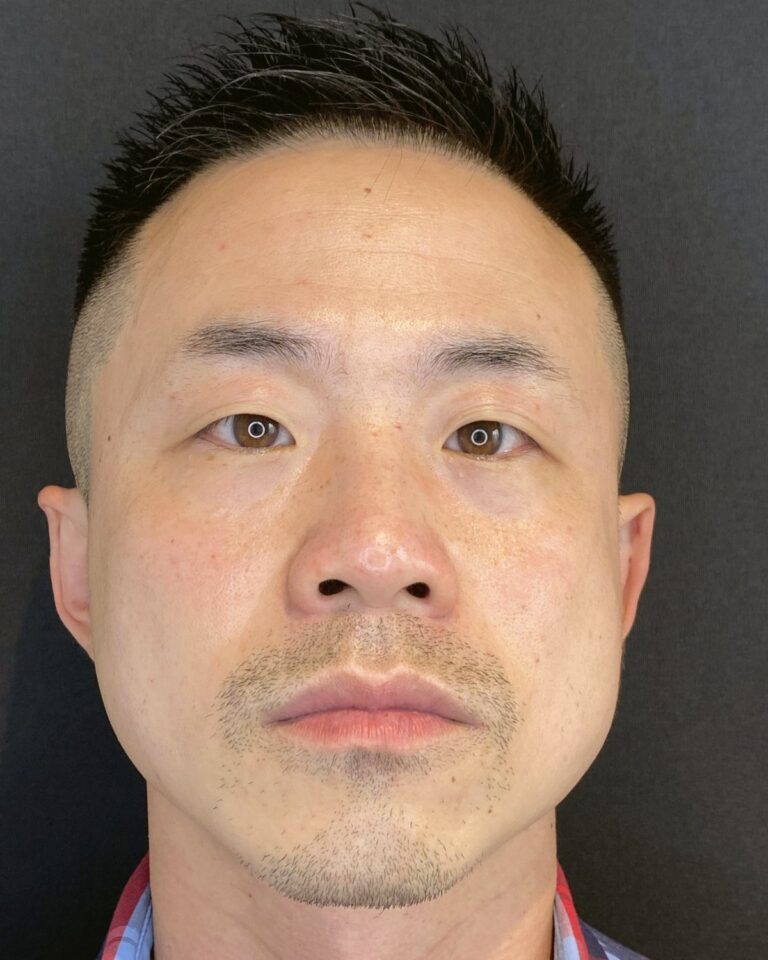 Før: Botox i masseter for V-shape. Mand, 33 år.