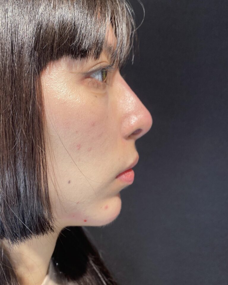 Efter, lige efter behandlingen: Næse korrigeret med 1 ml ikke-permanent filler. Kvinde, 29 år.