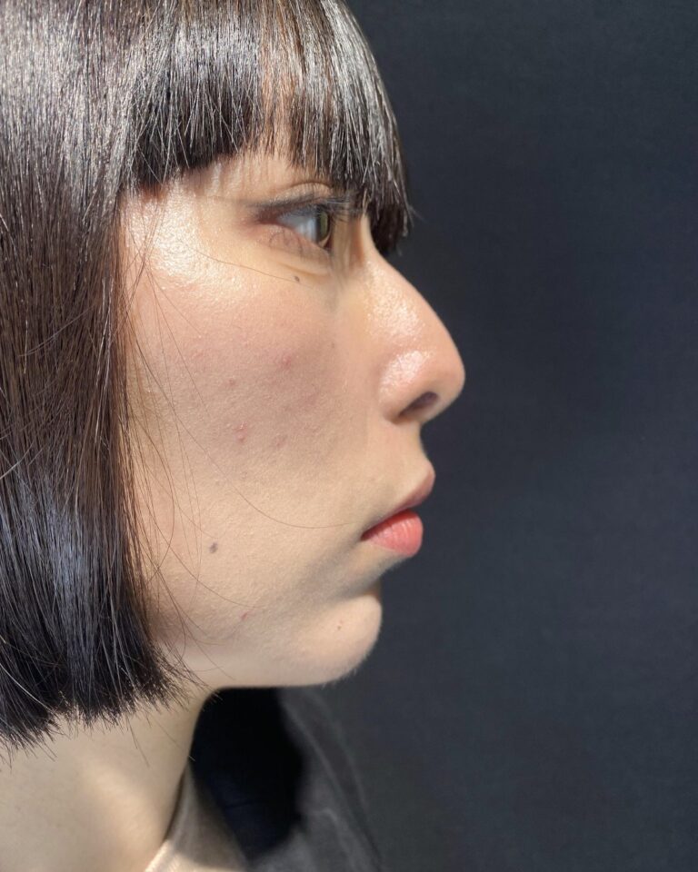 Før: Næse korrigeret med 1 ml ikke-permanent filler. Kvinde, 29 år.