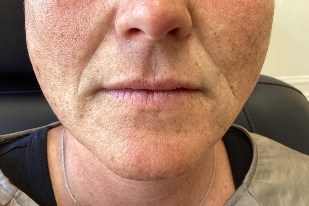 Før: Skinbooster mod linjer fra næse til mund, 1 ml. Kvinde, 45 år.