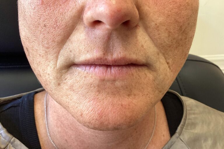 Før: Skinbooster mod linjer fra næse til mund, 1 ml. Kvinde, 45 år.