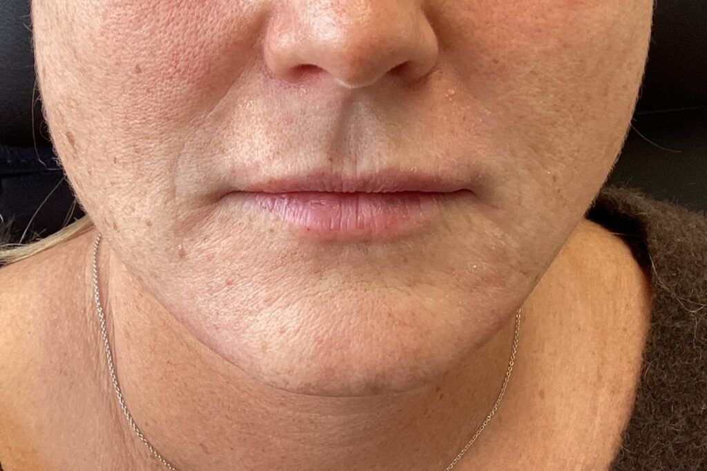 Efter, 4 uger efter behandlingen: Skinbooster mod linjer fra næse til mund, 1 ml. Kvinde, 45 år.