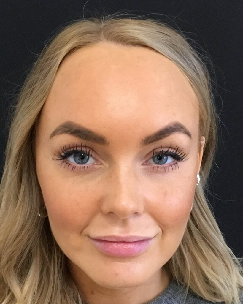 Efter, 2 uger efter behandlingen: Botox i panden. Kvinde, 25 år.