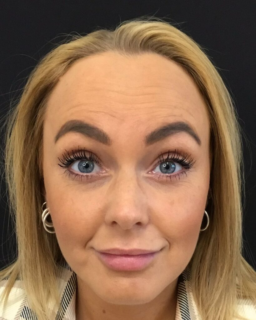 Før: Botox i panden. Kvinde, 25 år.