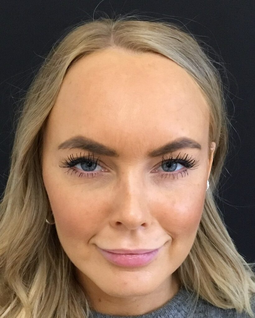 Efter, 2 uger efter behandlingen: Botox i glabella. Kvinde, 25 år.