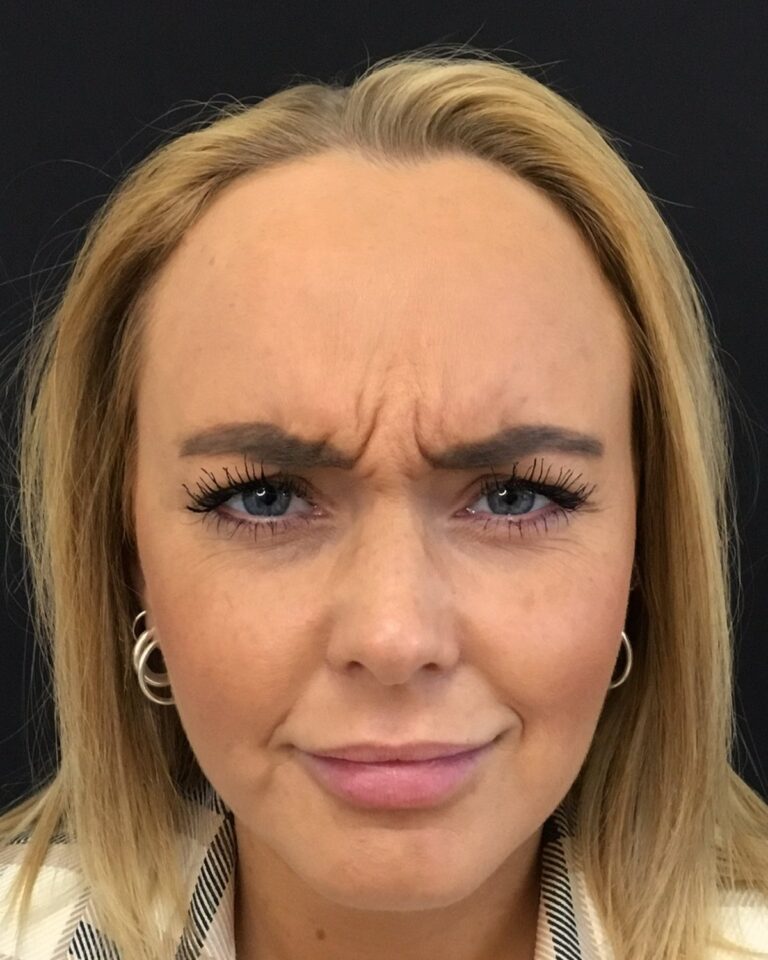 Før: Botox i glabella. Kvinde, 25 år.