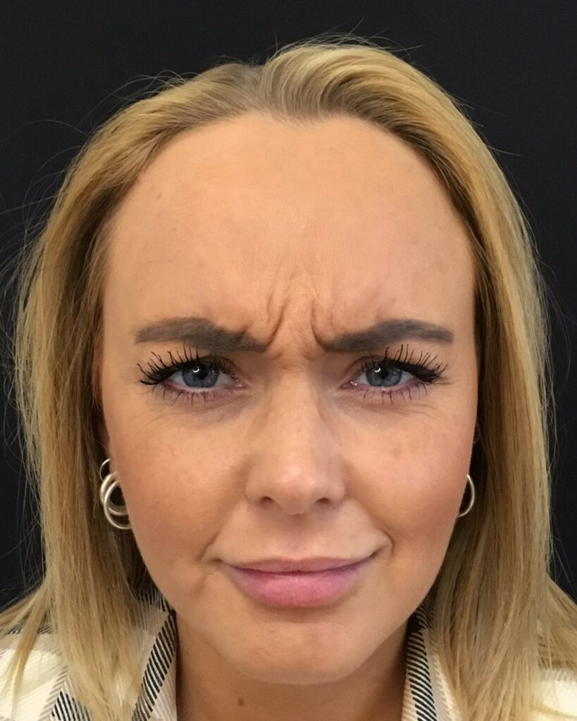 Før: Botox i glabella. Kvinde, 25 år.